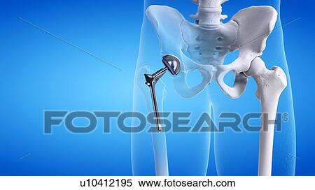 Hip replacement, illustration View Large Photo Image Stock Photography - Hip replacement, illustration. Fotosearch