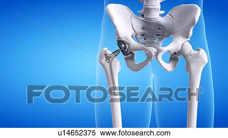 Hip replacement, illustration View Large Photo Image Stock Photography - Hip replacement, illustration. Fotosearch