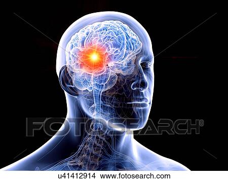 Picture - Human brain tumour, illustration. Fotosearch