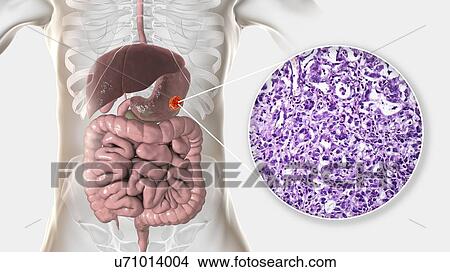 Human stomach adenocarcinoma, computer illustration and light micrograph. View Large Photo Image Picture - Human stomach adenocarcinoma, computer illustration and light micrograph.. Fotosearch