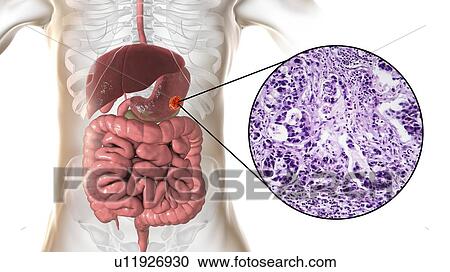 Human stomach adenocarcinoma, computer illustration and light micrograph. View Large Photo Image Stock Image - Human stomach adenocarcinoma, computer illustration and light micrograph.. Fotosearch