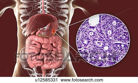 Human stomach adenocarcinoma, computer illustration and light micrograph. View Large Photo Image Stock Image - Human stomach adenocarcinoma, computer illustration and light micrograph.. Fotosearch