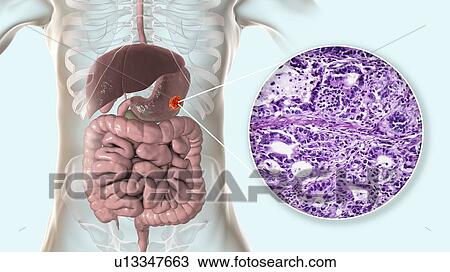 Stock Image - Human stomach adenocarcinoma, computer illustration and light micrograph.. Fotosearch