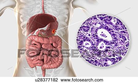 Stock Image - Human stomach adenocarcinoma, computer illustration and light micrograph.. Fotosearch