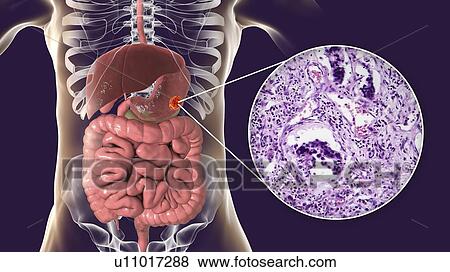 Stock Photo - Human stomach adenocarcinoma, computer illustration and light micrograph.. Fotosearch
