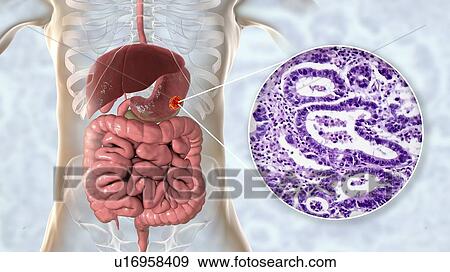 Human stomach adenocarcinoma, computer illustration and light micrograph. View Large Photo Image Stock Photo - Human stomach adenocarcinoma, computer illustration and light micrograph.. Fotosearch