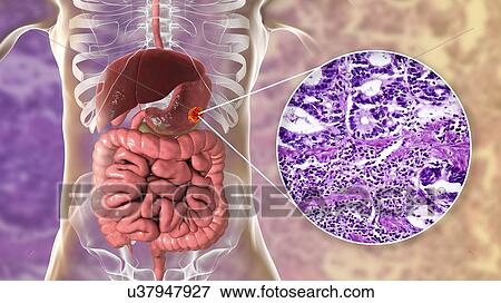Human stomach adenocarcinoma, computer illustration and light micrograph. View Large Photo Image Stock Photo - Human stomach adenocarcinoma, computer illustration and light micrograph.. Fotosearch