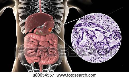 Human stomach adenocarcinoma, computer illustration and light micrograph. View Large Photo Image Stock Photo - Human stomach adenocarcinoma, computer illustration and light micrograph.. Fotosearch