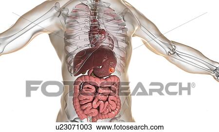 Human stomach cancer, computer illustration. View Large Photo Image Stock Image - Human stomach cancer, computer illustration.. Fotosearch