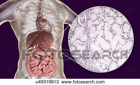 Human stomach mucinous adenocarcinoma, computer illustration and light micrograph. View Large Photo Image Stock Image - Human stomach mucinous adenocarcinoma, computer illustration and light micrograph.. Fotosearch