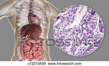 Human stomach mucinous adenocarcinoma, computer illustration and light micrograph. View Large Photo Image Stock Photo - Human stomach mucinous adenocarcinoma, computer illustration and light micrograph.. Fotosearch