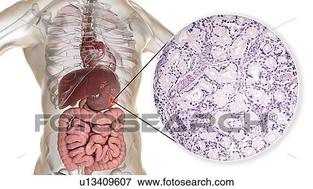 Stock Photo - Human stomach mucinous adenocarcinoma, computer illustration and light micrograph.. Fotosearch