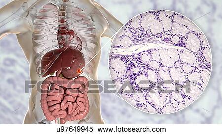 Stock Photography - Human stomach mucinous adenocarcinoma, computer illustration and light micrograph.. Fotosearch