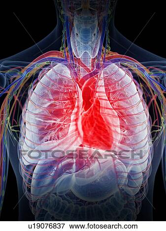 Inflamed heart, computer illustration. View Large Photo Image Stock Photo - Inflamed heart, computer illustration.. Fotosearch