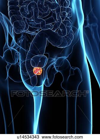 Stock Image - Inflamed prostate, illustration. Fotosearch