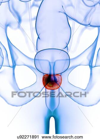 Inflamed prostate, illustration View Large Photo Image Stock Image - Inflamed prostate, illustration. Fotosearch