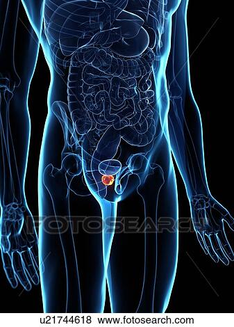 Stock Photo - Inflamed prostate, illustration. Fotosearch