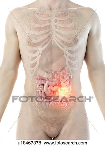 Stock Photo - Intestinal tumour, conceptual computer illustration.. Fotosearch