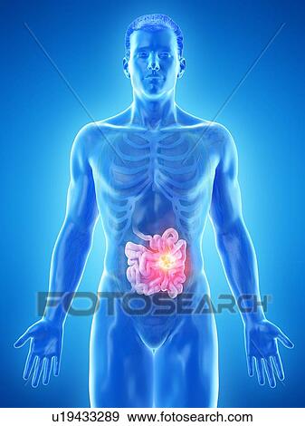 Stock Photo - Intestinal tumour, conceptual computer illustration.. Fotosearch