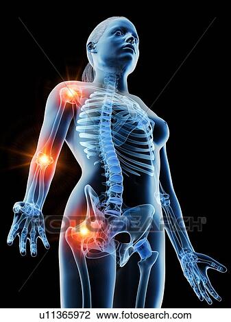 Stock Image - Joint pain, conceptual computer illustration.. Fotosearch