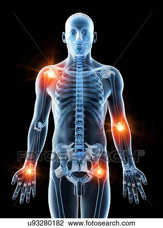 Joint pain, conceptual computer illustration. View Large Photo Image Stock Image - Joint pain, conceptual computer illustration.. Fotosearch