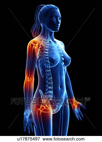 Stock Photo - Joint pain, conceptual computer illustration.. Fotosearch