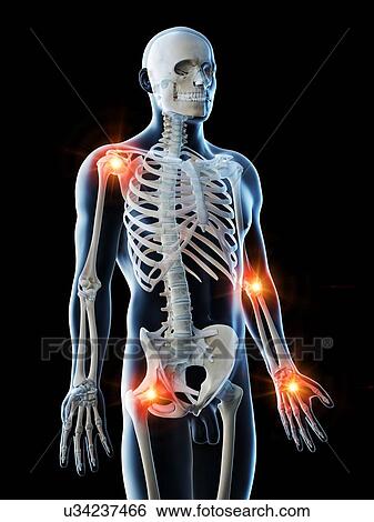 Joint pain, conceptual computer illustration. View Large Photo Image Stock Photograph - Joint pain, conceptual computer illustration.. Fotosearch