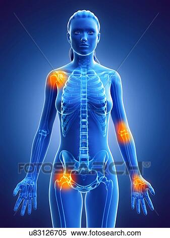 Stock Photography - Joint pain, conceptual computer illustration.. Fotosearch