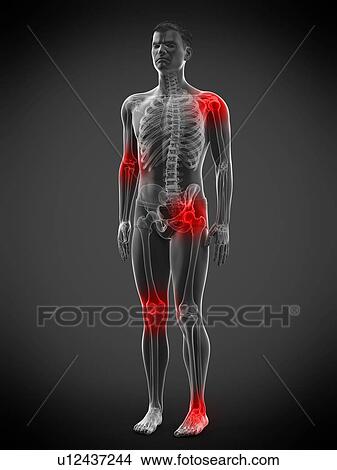 Picture - Joint pain, conceptual illustration.. Fotosearch