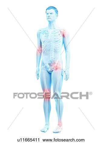 Stock Image - Joint pain, conceptual illustration.. Fotosearch