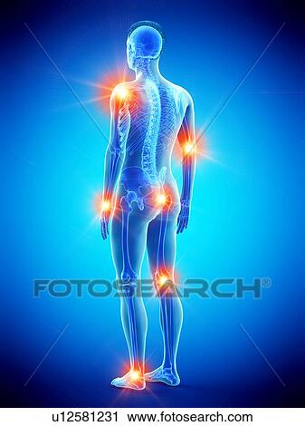 Stock Image - Joint pain, conceptual illustration.. Fotosearch
