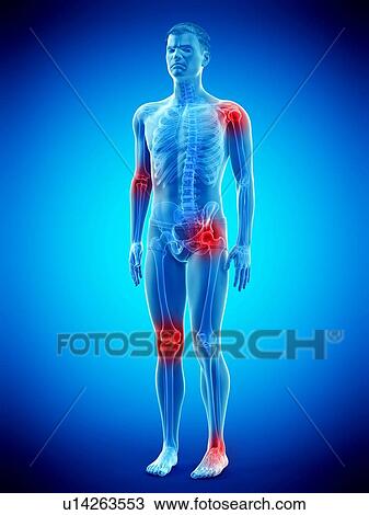 Stock Image - Joint pain, conceptual illustration.. Fotosearch