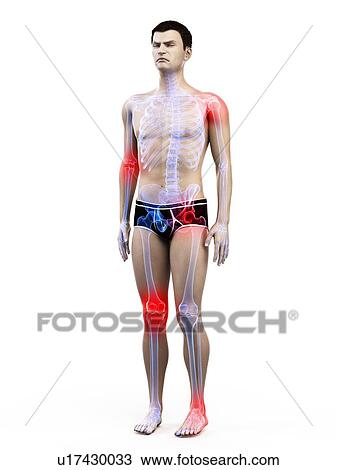Joint pain, conceptual illustration. View Large Photo Image Stock Image - Joint pain, conceptual illustration.. Fotosearch