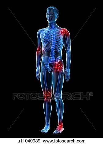 Stock Photo - Joint pain, conceptual illustration.. Fotosearch