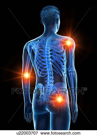 Stock Photo - Joint pain, conceptual illustration.. Fotosearch
