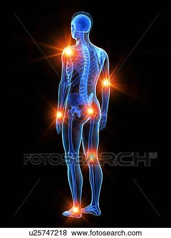 Stock Photo - Joint pain, conceptual illustration.. Fotosearch