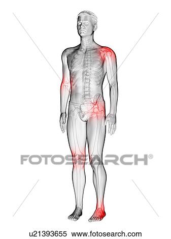 Stock Photography - Joint pain, conceptual illustration.. Fotosearch