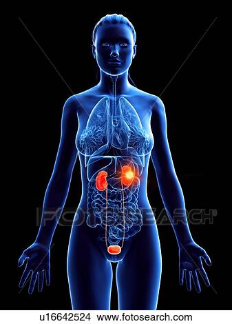 Kidney cancer, conceptual computer illustration. View Large Photo Image Picture - Kidney cancer, conceptual computer illustration.. Fotosearch