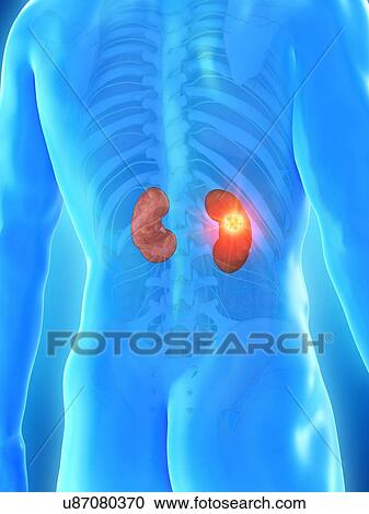 Stock Image - Kidney cancer, conceptual computer illustration.. Fotosearch