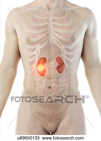 Stock Image - Kidney cancer, conceptual computer illustration.. Fotosearch