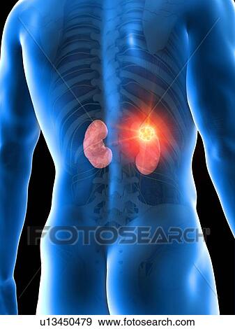 Kidney cancer, conceptual computer illustration. View Large Photo Image Stock Photo - Kidney cancer, conceptual computer illustration.. Fotosearch