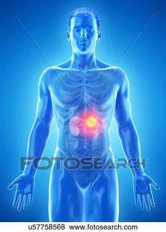 Kidney cancer, conceptual computer illustration. View Large Photo Image Stock Photo - Kidney cancer, conceptual computer illustration.. Fotosearch