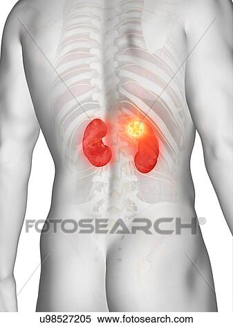 Stock Photography - Kidney cancer, conceptual computer illustration.. Fotosearch