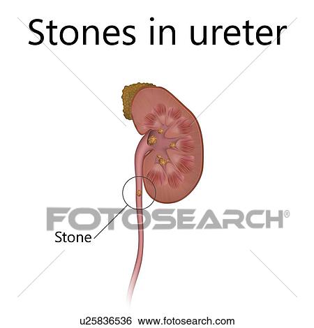 Kidney with stones in ureter, illustration View Large Photo Image Stock Photograph - Kidney with stones in ureter, illustration. Fotosearch