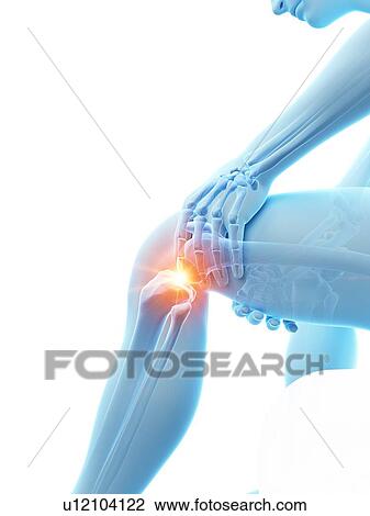 Stock Image - Knee pain, conceptual illustration.. Fotosearch