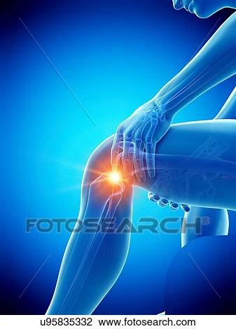 Stock Image - Knee pain, conceptual illustration.. Fotosearch