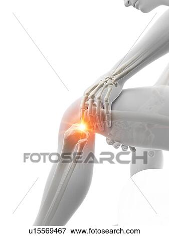 Stock Photo - Knee pain, conceptual illustration.. Fotosearch