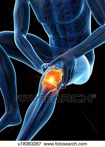 Stock Photo - Knee pain, conceptual illustration.. Fotosearch