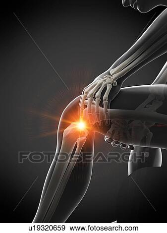 Stock Photo - Knee pain, conceptual illustration.. Fotosearch