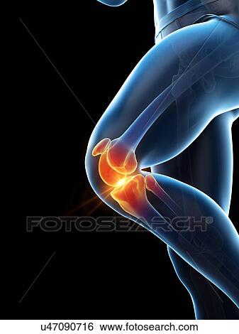 knee pain, conceptual illustration. View Large Photo Image Stock Photograph - knee pain, conceptual illustration.. Fotosearch
